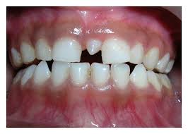 Supernumerary teeth, primary dentition